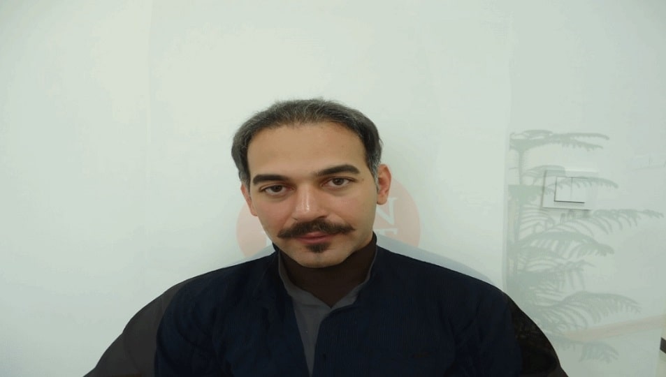 نمونه کاشت مو
