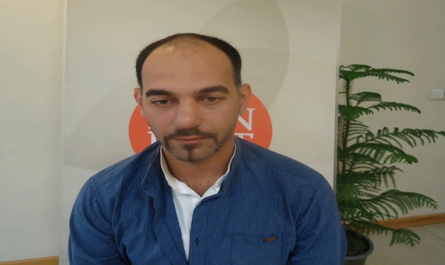 نمونه کاشت مو