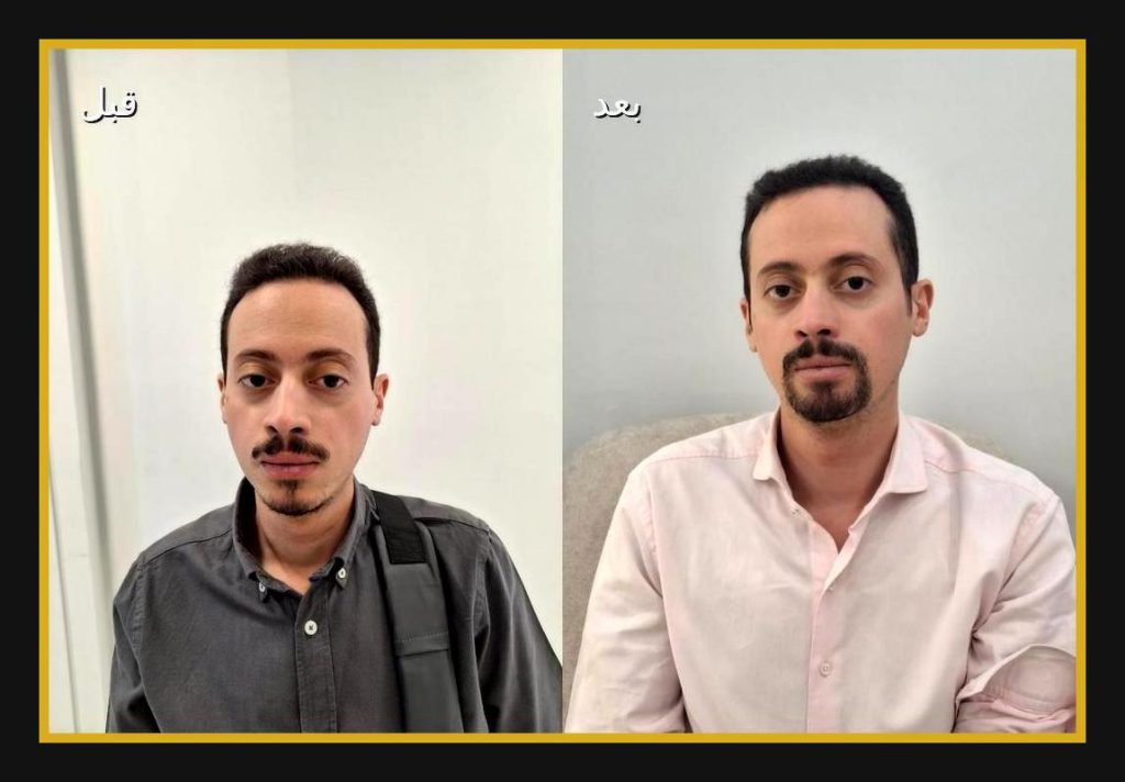 کاشت ریش